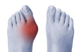 Understanding and Managing Common Foot Ailments: Bunions, Hammer Toes, and Overlapping Toes